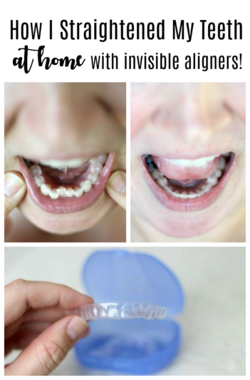 best invisible aligners